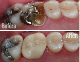 Great Results as your CEREC Crown is fitted at Bridge Dental - Before and After Images.