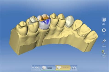 Your Crown is designed with 3D software